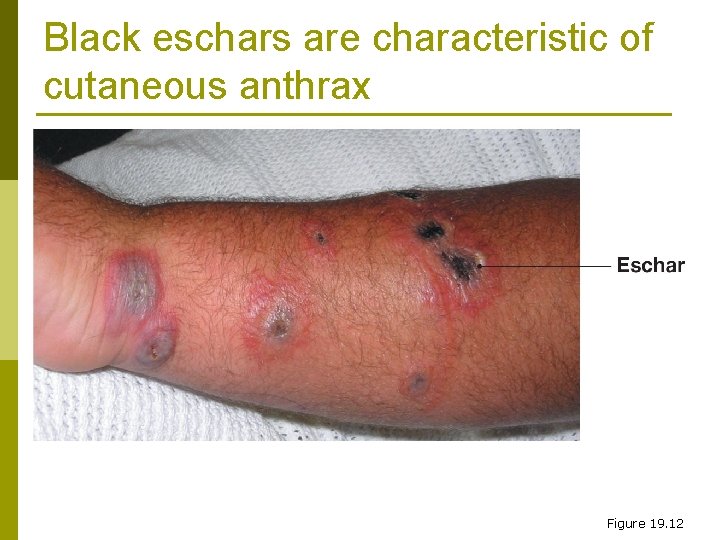 Black eschars are characteristic of cutaneous anthrax Figure 19. 12 