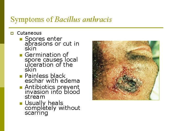 Symptoms of Bacillus anthracis p Cutaneous n Spores enter n n abrasions or cut