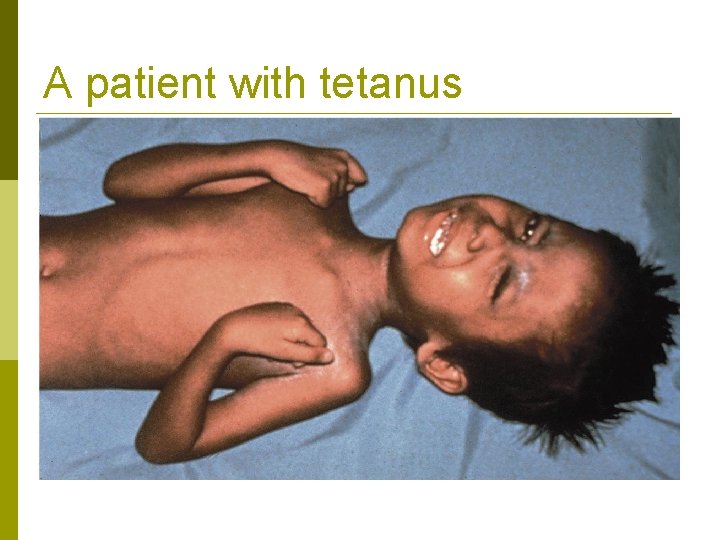 A patient with tetanus 