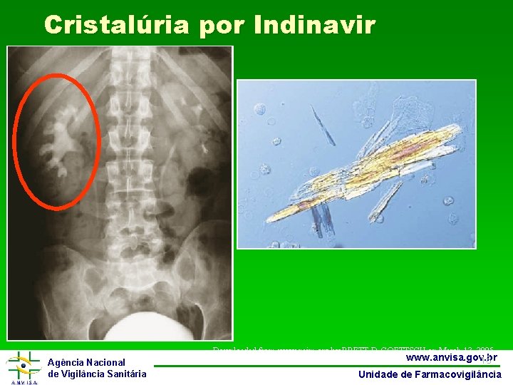 Cristalúria por Indinavir Downloaded from www. nejm. org by BRETT D. GOETTSCH on March