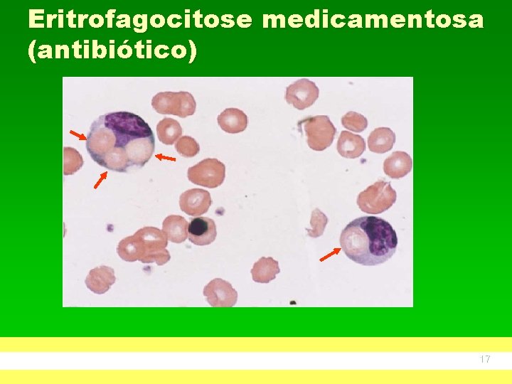 Eritrofagocitose medicamentosa (antibiótico) www. anvisa. gov. br Fonte: G. IAMBATTISTA; L. OBREGLIO, M. D,