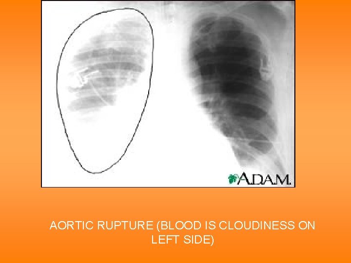 AORTIC RUPTURE (BLOOD IS CLOUDINESS ON LEFT SIDE) 