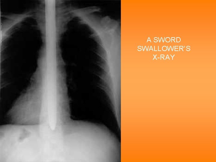 A SWORD SWALLOWER’S X-RAY 
