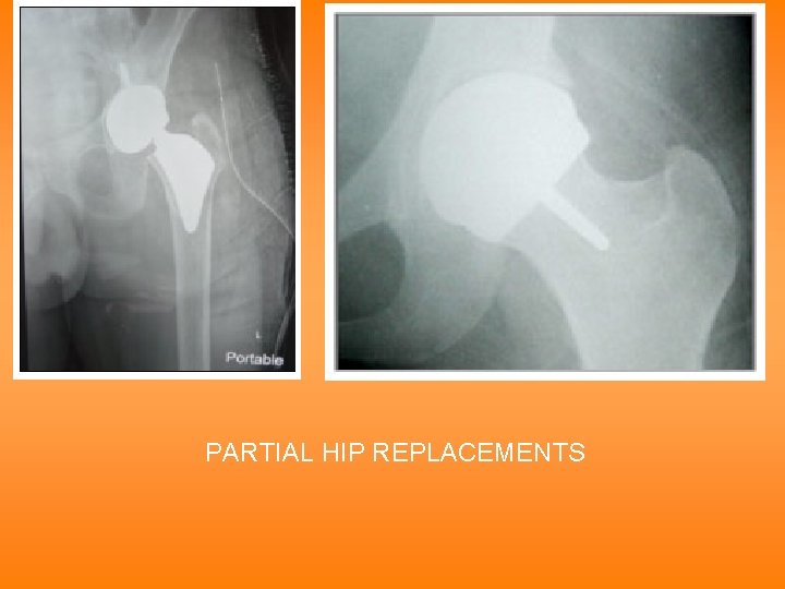 PARTIAL HIP REPLACEMENTS 