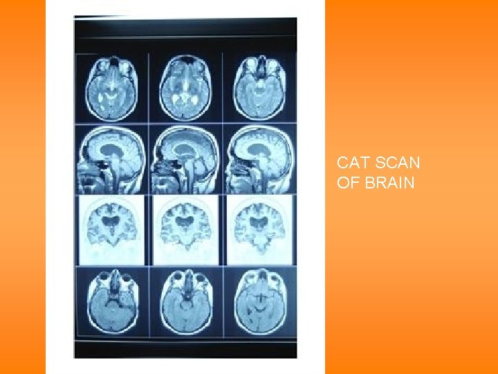 CAT SCAN OF BRAIN 