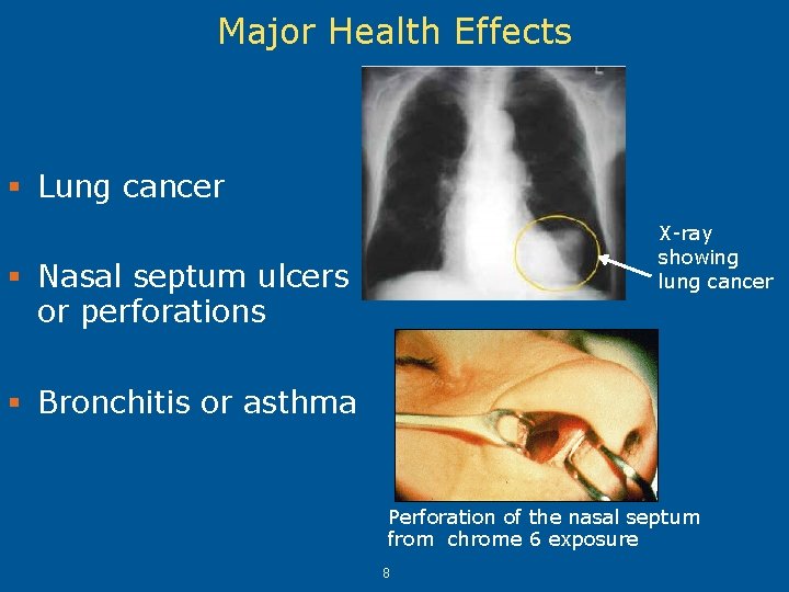 Major Health Effects § Lung cancer X-ray showing lung cancer § Nasal septum ulcers Major Health Effects § Lung cancer X-ray showing lung cancer § Nasal septum ulcers