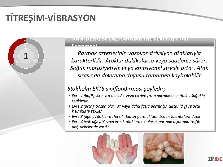 TİTREŞİM-VİBRASYON 1 VASKÜLER/BEYAZ PARMAK-Mesleki Raynaud Fenomeni Parmak arterlerinin vazokonstriksiyon ataklarıyla karakterlidir. Ataklar dakikalarca veya