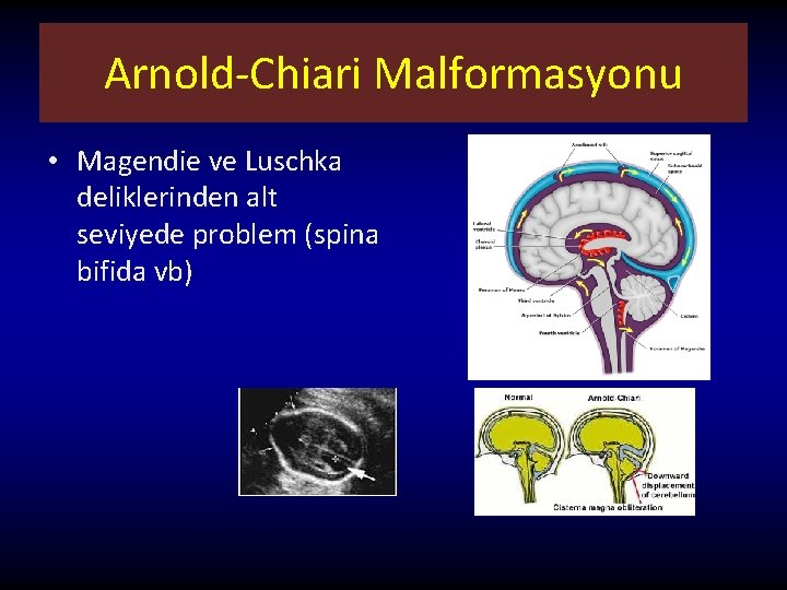 Arnold-Chiari Malformasyonu • Magendie ve Luschka deliklerinden alt seviyede problem (spina bifida vb) 