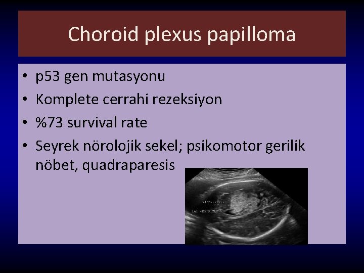 Choroid plexus papilloma • • p 53 gen mutasyonu Komplete cerrahi rezeksiyon %73 survival