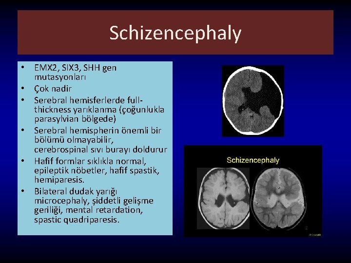 Schizencephaly • EMX 2, SIX 3, SHH gen mutasyonları • Çok nadir • Serebral