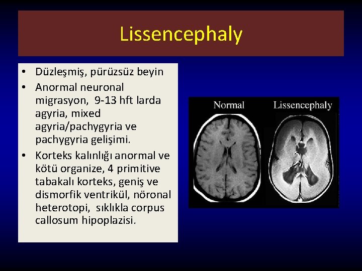 Lissencephaly • Düzleşmiş, pürüzsüz beyin • Anormal neuronal migrasyon, 9 -13 hft larda agyria,