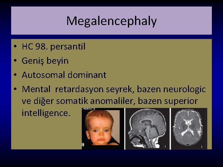 Megalencephaly • • HC 98. persantil Geniş beyin Autosomal dominant Mental retardasyon seyrek, bazen