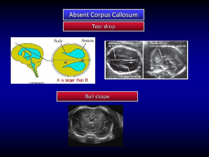 Absent Corpus Callosum Tear drop Bull shape 