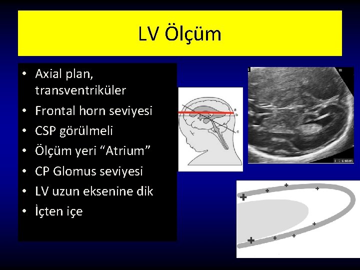 LV Ölçüm • Axial plan, transventriküler • Frontal horn seviyesi • CSP görülmeli •
