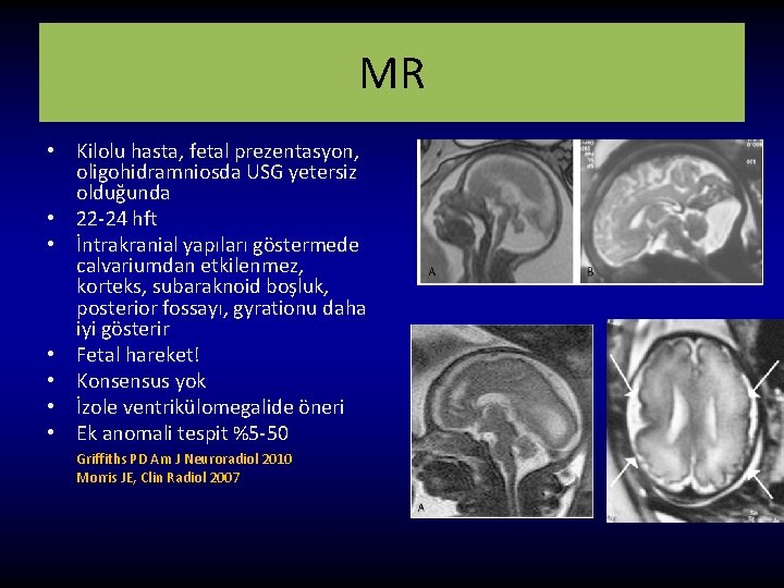 MR • Kilolu hasta, fetal prezentasyon, oligohidramniosda USG yetersiz olduğunda • 22 -24 hft