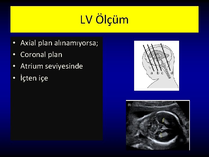 LV Ölçüm • • Axial plan alınamıyorsa; Coronal plan Atrium seviyesinde İçten içe 