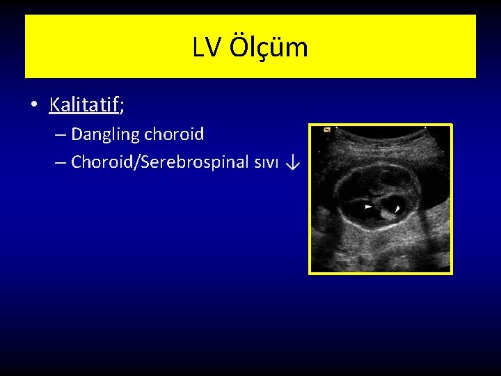 LV Ölçüm • Kalitatif; – Dangling choroid – Choroid/Serebrospinal sıvı ↓ 