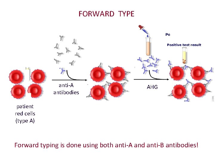 FORWARD TYPE anti-A antibodies AHG patient red cells (type A) Forward typing is done