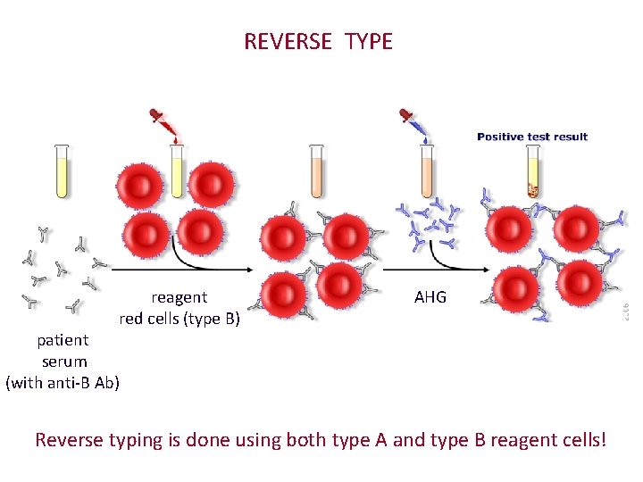 REVERSE TYPE reagent red cells (type B) AHG patient serum (with anti-B Ab) Reverse