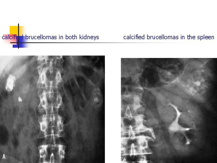calcified brucellomas in both kidneys calcified brucellomas in the spleen calcified brucellomas in both kidneys calcified brucellomas in the spleen