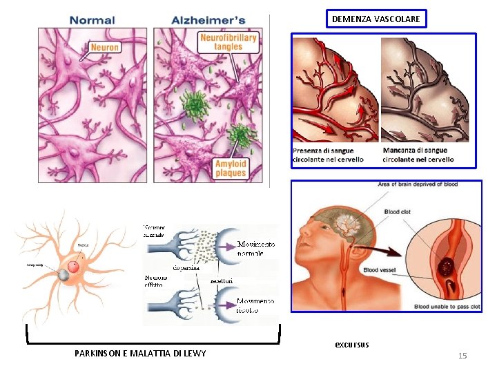 DEMENZA VASCOLARE PARKINSON E MALATTIA DI LEWY excursus 15 DEMENZA VASCOLARE PARKINSON E MALATTIA DI LEWY excursus 15