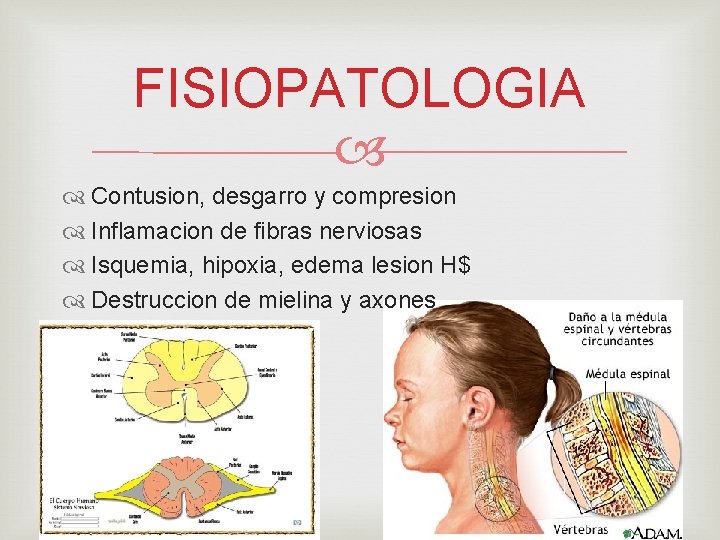 FISIOPATOLOGIA Contusion, desgarro y compresion Inflamacion de fibras nerviosas Isquemia, hipoxia, edema lesion H$
