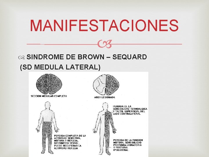 MANIFESTACIONES SINDROME DE BROWN – SEQUARD (SD MEDULA LATERAL) 