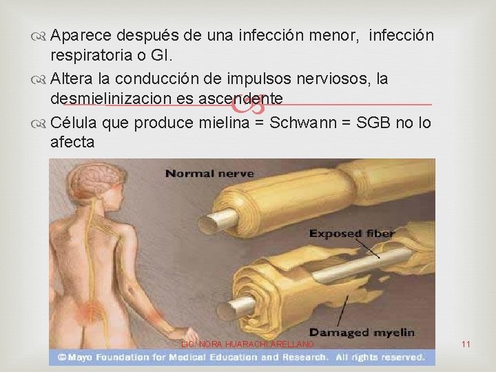  Aparece después de una infección menor, infección respiratoria o GI. Altera la conducción