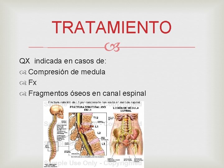 TRATAMIENTO QX indicada en casos de: Compresión de medula Fx Fragmentos óseos en canal