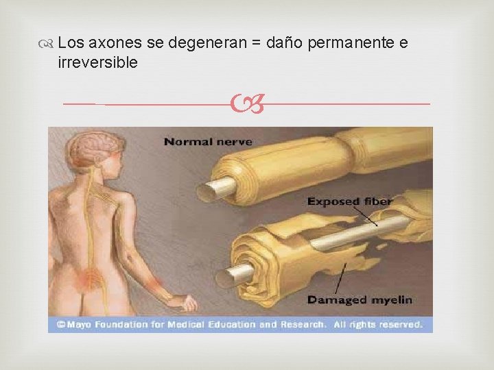  Los axones se degeneran = daño permanente e irreversible 