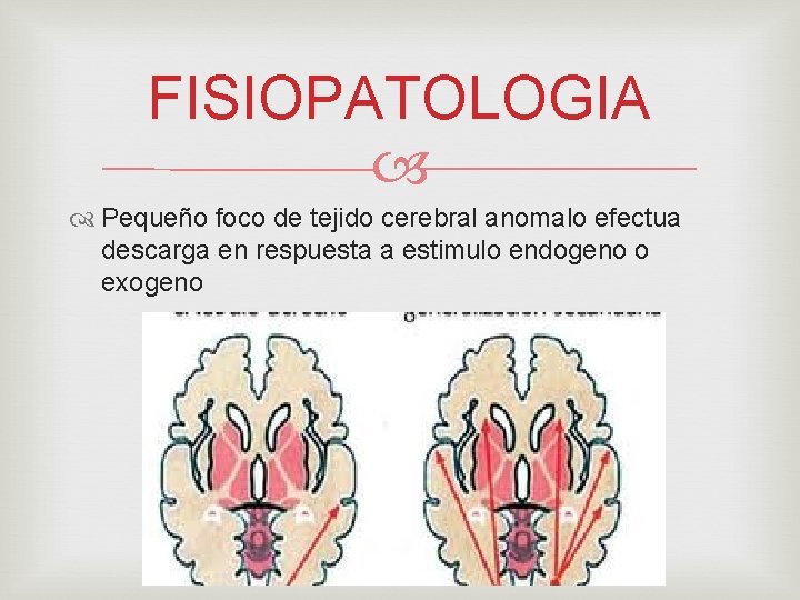 FISIOPATOLOGIA Pequeño foco de tejido cerebral anomalo efectua descarga en respuesta a estimulo endogeno