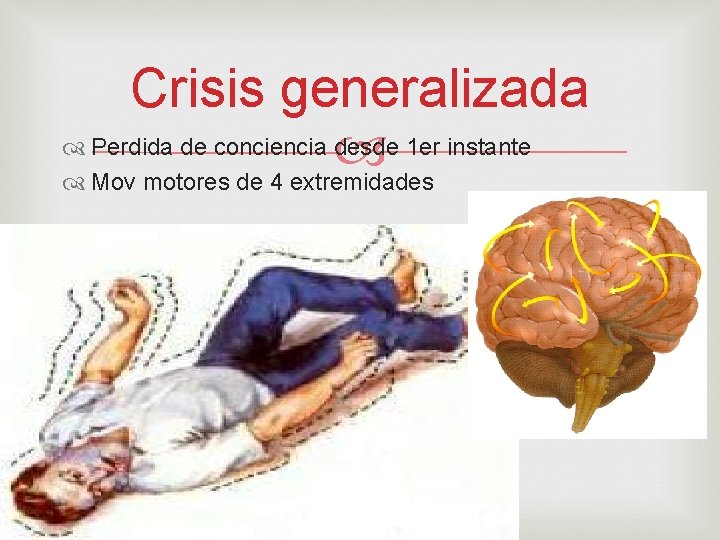 Crisis generalizada Perdida de conciencia desde 1 er instante Mov motores de 4 extremidades