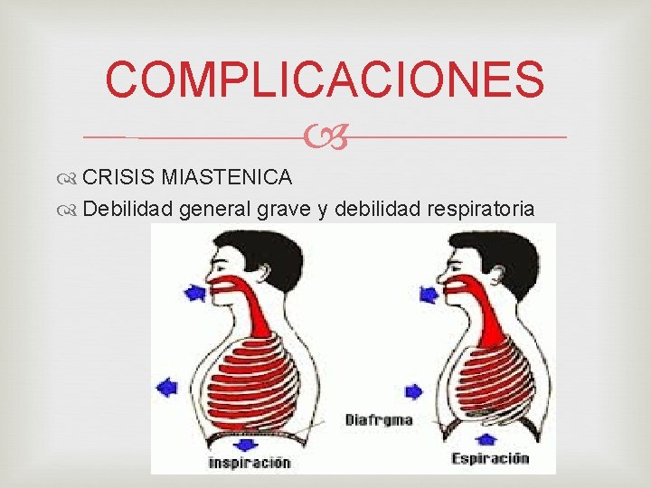 COMPLICACIONES CRISIS MIASTENICA Debilidad general grave y debilidad respiratoria 