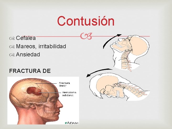 Contusión Cefalea Mareos, irritabilidad Ansiedad FRACTURA DE 