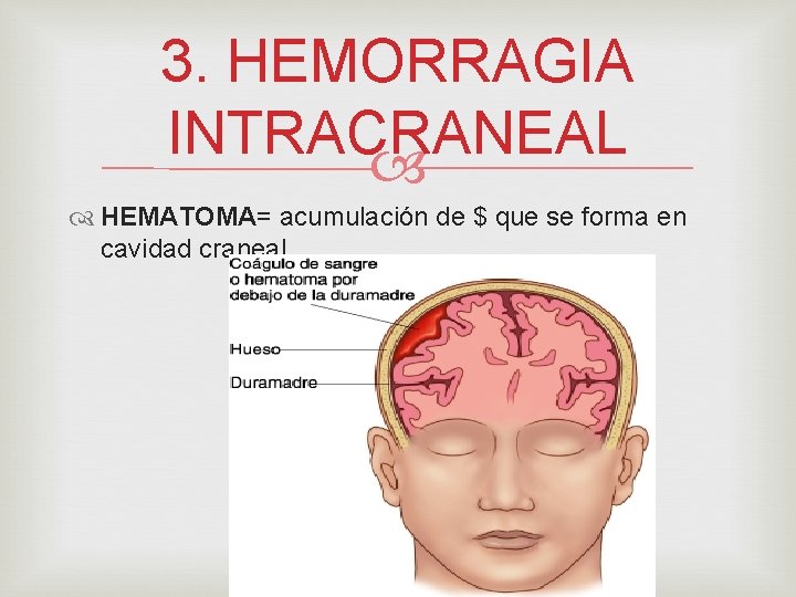 3. HEMORRAGIA INTRACRANEAL HEMATOMA= acumulación de $ que se forma en cavidad craneal 