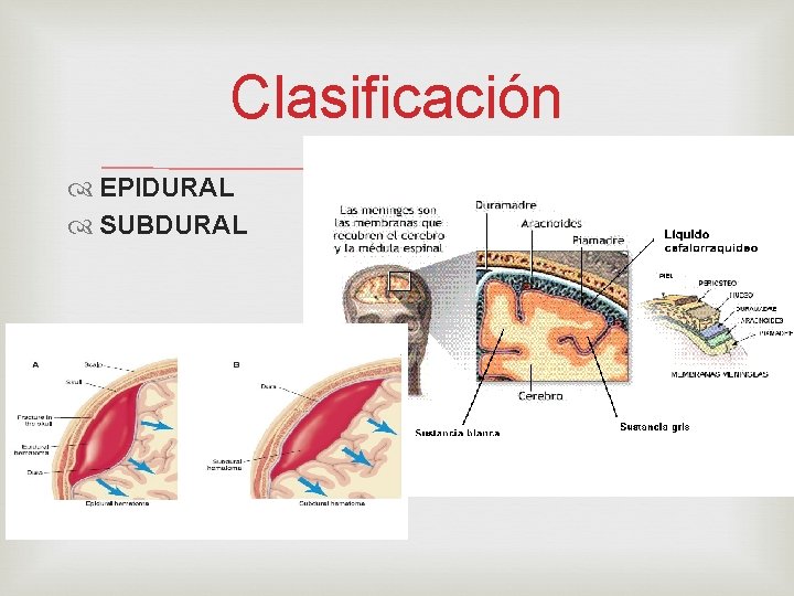 Clasificación EPIDURAL SUBDURAL 