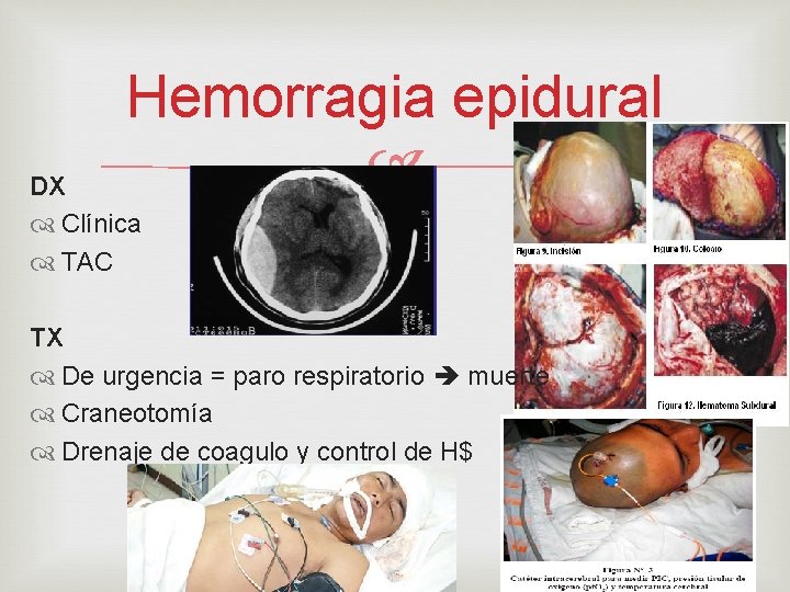 Hemorragia epidural DX Clínica TAC TX De urgencia = paro respiratorio muerte Craneotomía Drenaje