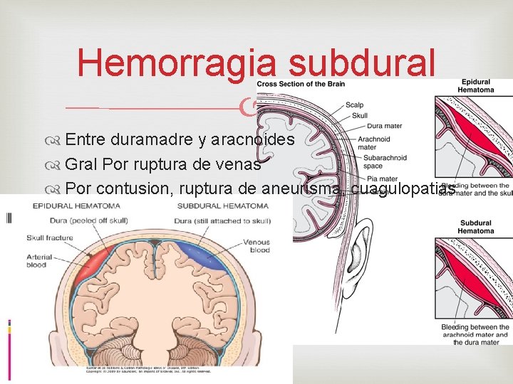 Hemorragia subdural Entre duramadre y aracnoides Gral Por ruptura de venas Por contusion, ruptura