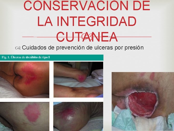 CONSERVACION DE LA INTEGRIDAD CUTANEA Cuidados de prevención de ulceras por presión 