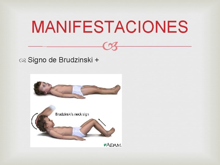 MANIFESTACIONES Signo de Brudzinski + 