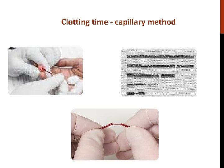 Clotting time - capillary method 