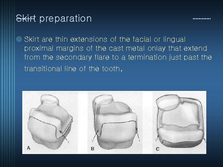 Skirt preparation ¥ Skirt are thin extensions of the facial or lingual proximal margins
