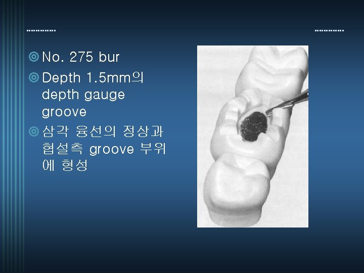 ¥ No. 275 bur ¥ Depth 1. 5 mm의 depth gauge groove ¥ 삼각