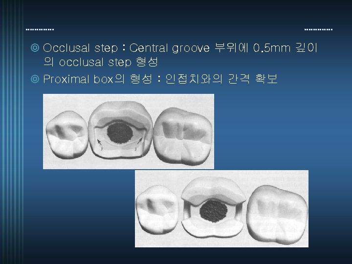 ¥ Occlusal step : Central groove 부위에 0. 5 mm 깊이 의 occlusal step