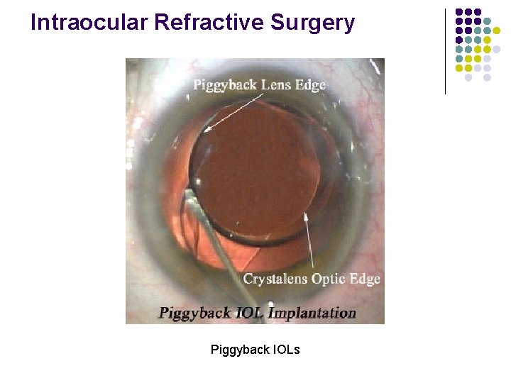 Intraocular Refractive Surgery Piggyback IOLs 