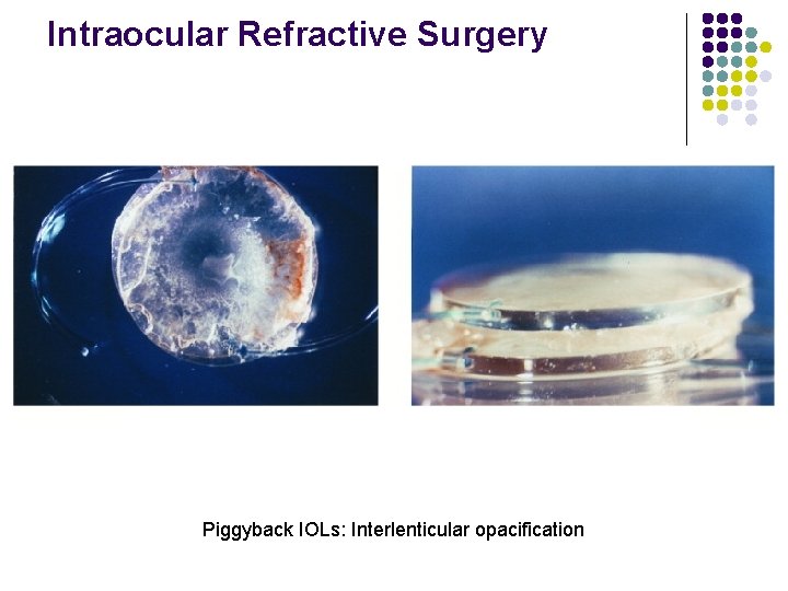 Intraocular Refractive Surgery Piggyback IOLs: Interlenticular opacification 