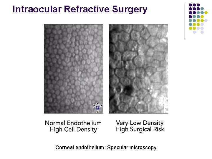 Intraocular Refractive Surgery Corneal endothelium: Specular microscopy 