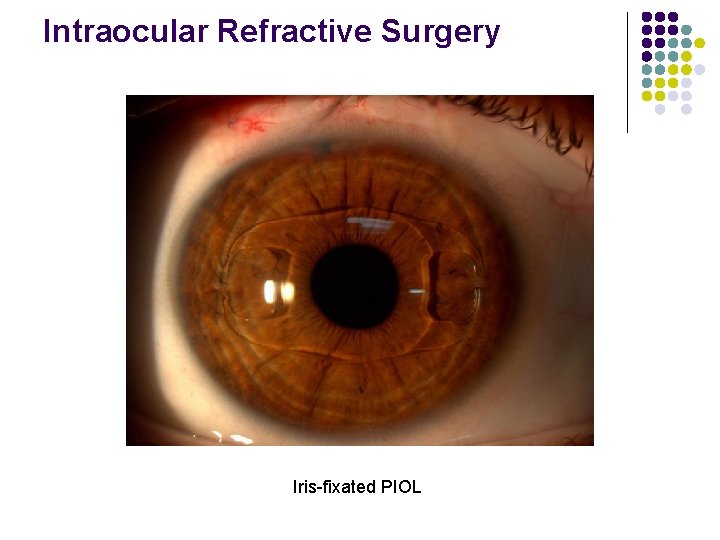 Intraocular Refractive Surgery Iris-fixated PIOL 