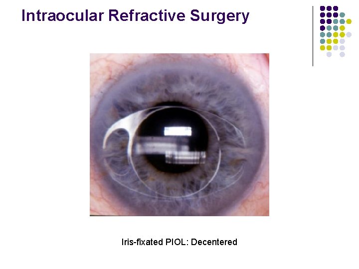 Intraocular Refractive Surgery Iris-fixated PIOL: Decentered 