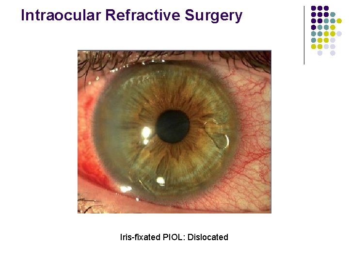 Intraocular Refractive Surgery Iris-fixated PIOL: Dislocated 